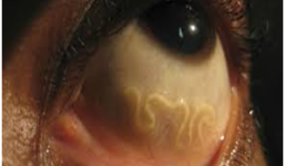 Ăn nem thính bị sán lợn làm tổ trong não