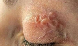 Ấu trùng, giun, sán 'tung tăng' trong cơ thể người