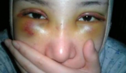 Thiếu nữ Việt rước họa vào thân vì muốn đẹp lên tức thì