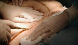 Phẫu thuật thẩm mỹ hút mỡ bụng, tổng giám đốc tử vong trên bàn mổ