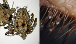 Rận mu xuất hiện: Triệu chứng bệnh và cách phòng tránh