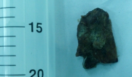 Hoại tử ruột vì nuốt...2 răng giả