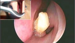 Kỳ lạ: Người đàn ông có răng mọc trong lỗ mũi