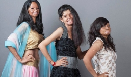 Ảnh người mẫu bị tạt axit gây chấn động