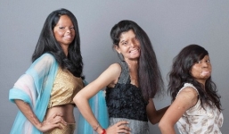 Những khuôn mặt người mẫu biến dạng vì bị tạt axit gây ám ảnh 