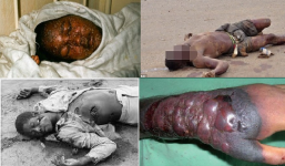 Dịch Ebola: Nữ y tá nghi nhiễm Ebola bỏ trốn khỏi khu cách ly