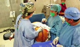 Khối u buồng trứng 60kg lớn nhất thế giới