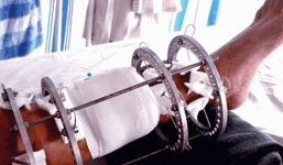 Chịu cực hình kéo xương để có chân dài tại TP.HCM