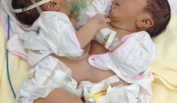 Cặp song sinh dính liền nhau Quang Anh - Quang Nhật được phẫu thuật thành công