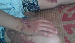 Lời kêu cứu xót xa của một nạn nhân bị tạt axit