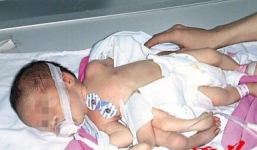 Thêm một bé sơ sinh chào đời với 4 tay, 4 chân trên cơ thể