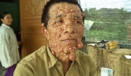 Hai mối tình của người đàn ông mọc u khắp cơ thể