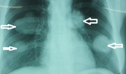 Kinh hãi phát hiện hàng nghìn sán chó làm tổ trong phổi người