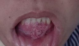 Vợ la khóc khi đốt sùi mào gà, chồng che mặt xấu hổ