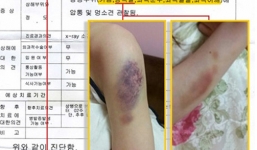 Bạn gái Kim Hyun Joong công khai hình ảnh bị đánh thương tích đầy mình