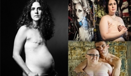 Bộ ảnh của bệnh nhân ung thư vú sau phẫu thuật gây xúc động