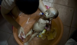 Mắc bệnh lạ, bé gái 1 tuổi nặng 3kg giống y người ngoài hành tinh