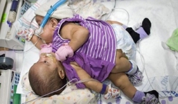 Ngực và bụng dính liền, cặp song sinh vẫn sống sót kỳ diệu