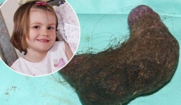 Bé gái 5 tuổi bị mắc khối tóc lớn trong dạ dày