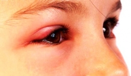 Mẹo chữa bệnh lẹo mắt hiệu quả, nhanh khỏi