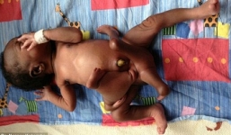 Kỳ lạ đứa trẻ mới sinh có 4 chân, 4 tay