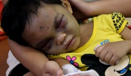 Nên truất quyền nuôi con của bà mẹ ác quỷ đánh con biến dạng mặt?