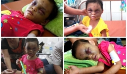 Tạm giữ hình sự cặp vợ chồng đánh bé gái 4 tuổi chấn thương sọ não