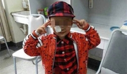 Bé trai trúng gần 130 viên đạn vào mặt vẫn may mắn sống sót