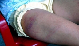 Uống rượu xong rút thắt lưng đánh con 6 tuổi tới tấp để 'đuổi ma'