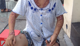 Cuộc sống sau chấn động: Bi kịch của người phụ nữ bỗng dưng bị tạt axit