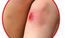 Cách chữa bỏng bô xe máy nhanh khỏi không để lại sẹo