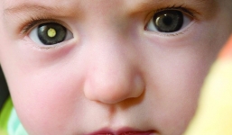 Cảnh báo bệnh nguy hiểm chết người qua đôi mắt