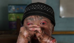 'Cậu bé rắn' cứ 41 ngày phải lột da một lần