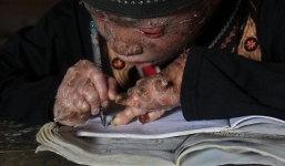 Cuộc sống của cậu bé người rắn 41 ngày lột da một lần