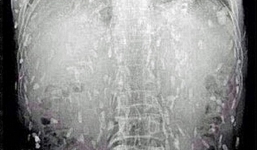 Hàng triệu con sán xơ mít làm tổ khắp cơ thể vì nghiện món sushi