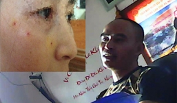 Thầy bói đâm kim vào mặt khách để “di cung, đổi số”