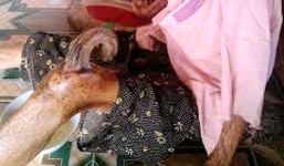 Cụ bà gần trăm tuổi mọc sừng dài giữa đầu gối