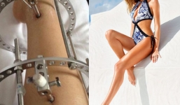 Thẩm mỹ kéo dài chân: Đọc xong, bạn có dám thử?