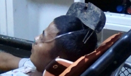 Thoát chết hy hữu khi bị 2 thanh sắt xuyên vào não