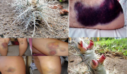 Tận mục loài sâu róm cực độc giết người bằng bộ lông ma quái