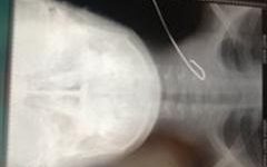 Cứu sống bé trai 11 tuổi bị cọng thép đâm thủng tĩnh mạch