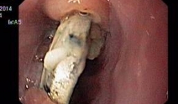 Cục pin hoen gỉ trong thực quản bé trai 2 tuổi