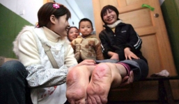 'Dị nhân' có bàn chân xoay ngược 180 độ