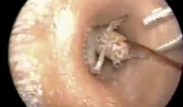 Kinh ngạc gắp con dế khổng lồ làm tổ trong lỗ tai người