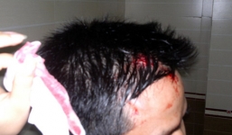 'Thượng đế' bị nhân viên karaoke đánh rách đầu