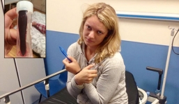 Nữ du khách bị đỉa dài 8 cm 'làm tổ' trong mũi gần 1 tháng