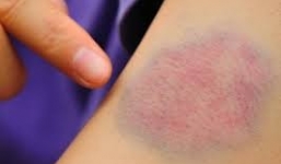 Chảy máu suốt 3 năm vì ăn thịt chó