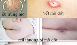 Bệnh sốt mò tái xuất: Triệu chứng và cách phòng bệnh