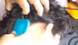 Choáng với cô bé nuôi hàng nghìn con chấy trên đầu