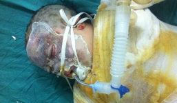 Cả nhà bị bỏng nặng vì lấy xăng tẩy nhựa đường